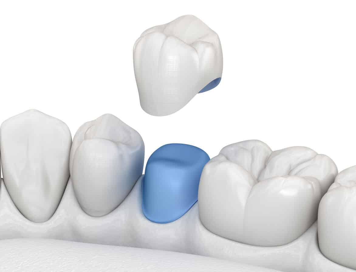 Types of Dental Crowns and Cost